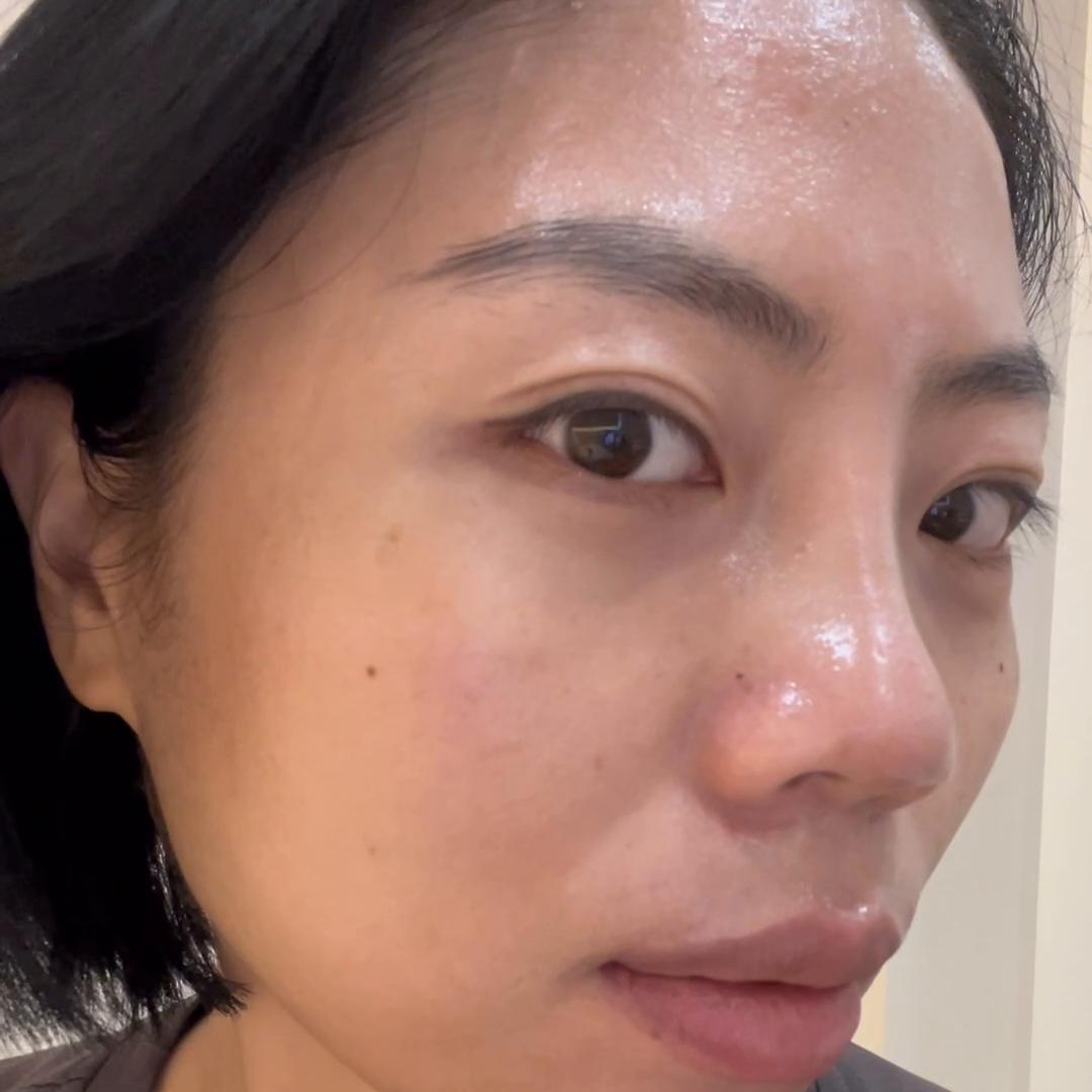 鼻子术后五个月了山根还是高,做完鼻子恢复后发现山根歪的