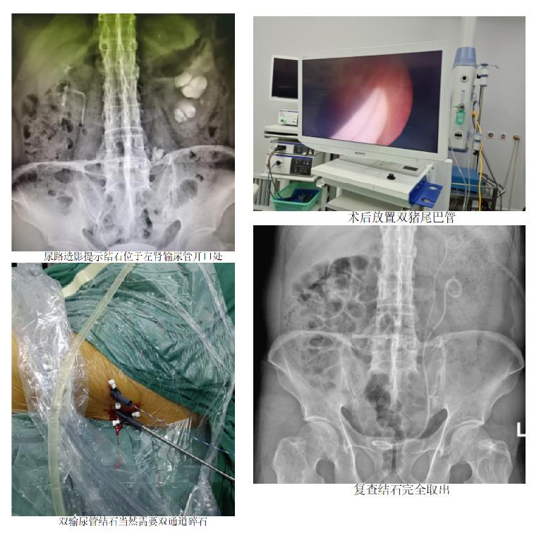 二院泌尿外科手术,平南县医院泌尿外科