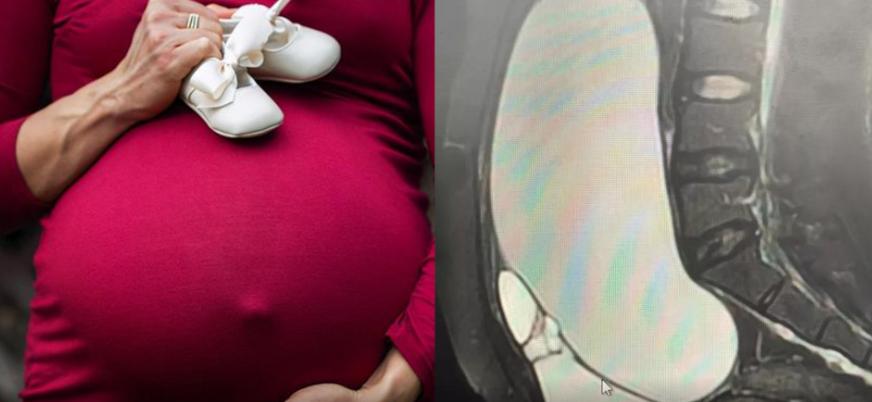 腹中20斤肿瘤女子如今怎么样了,25岁女孩腹内肿瘤