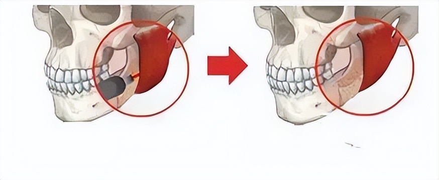 韦敏教授怎么样,瘦脸针和咬肌切除该怎么选