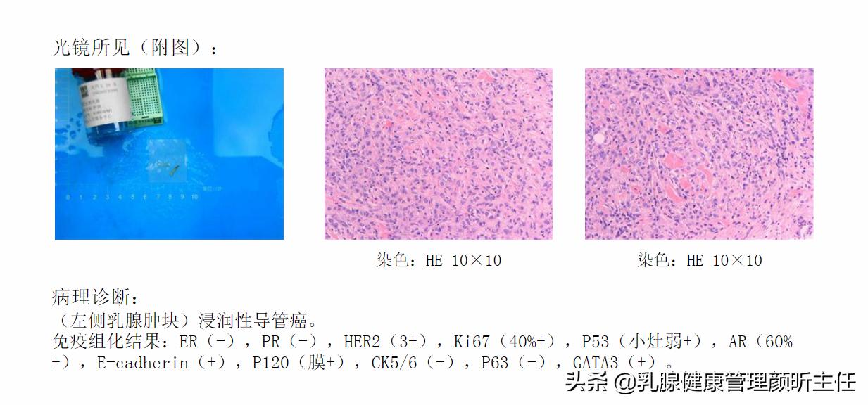 年轻人得了乳腺癌能治好吗,女性乳腺癌命运