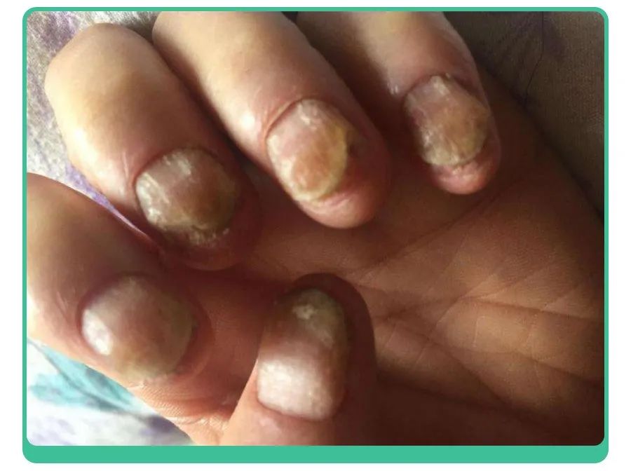 小孩指甲凹陷变黑有坑是什么原因,小孩指甲有白点和细纹是怎么回事