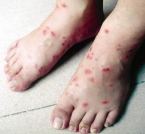 红火蚁被蜇伤的视频,被红火蚁咬哪里最危险