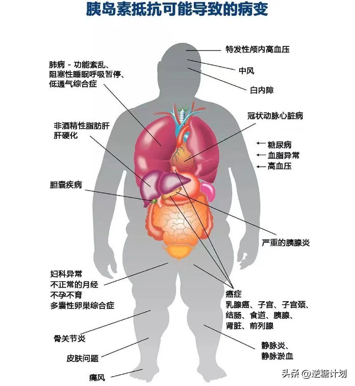 胰岛素水平高怎么办,胰岛素高怎么解决