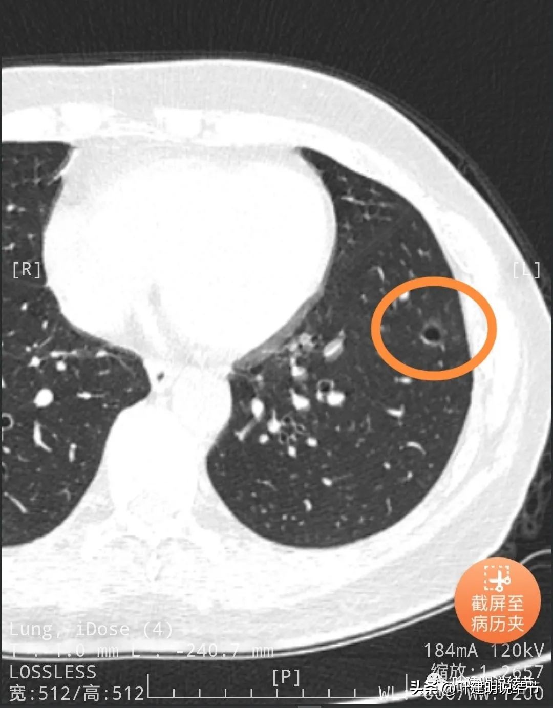 辽宁省肺结节手术哪家医院好,辽宁肺结节手术医院