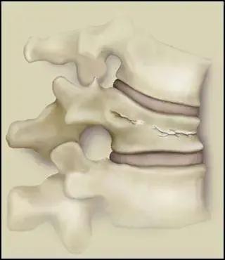 抻了一下动不了,抻了腰站不起来