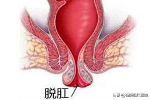 脱肛是怎么引起的如何治疗,脱肛的症状脱肛怎么治