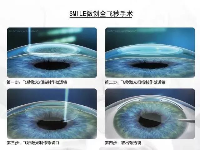 本想做近视手术，却发现眼底上破了个“洞”！需不需要治疗？