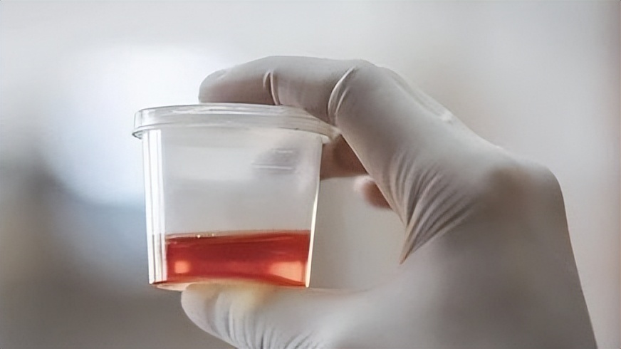 尿路感染的6个征兆,为什么突然之间就得了尿路感染