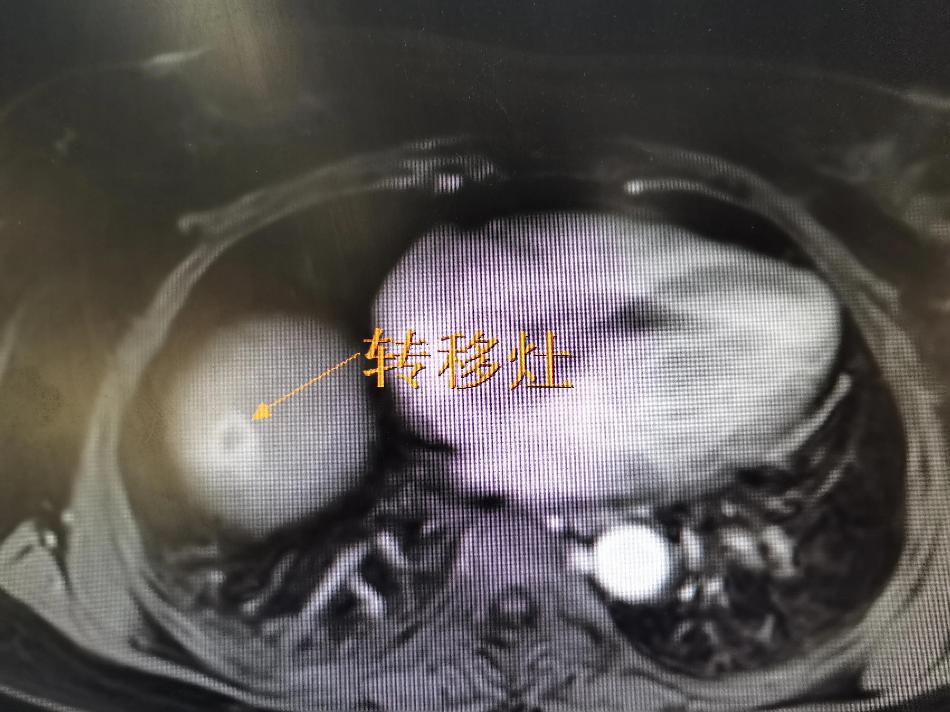 直肠癌肝转移肺,直肠癌肝转移靶向治疗