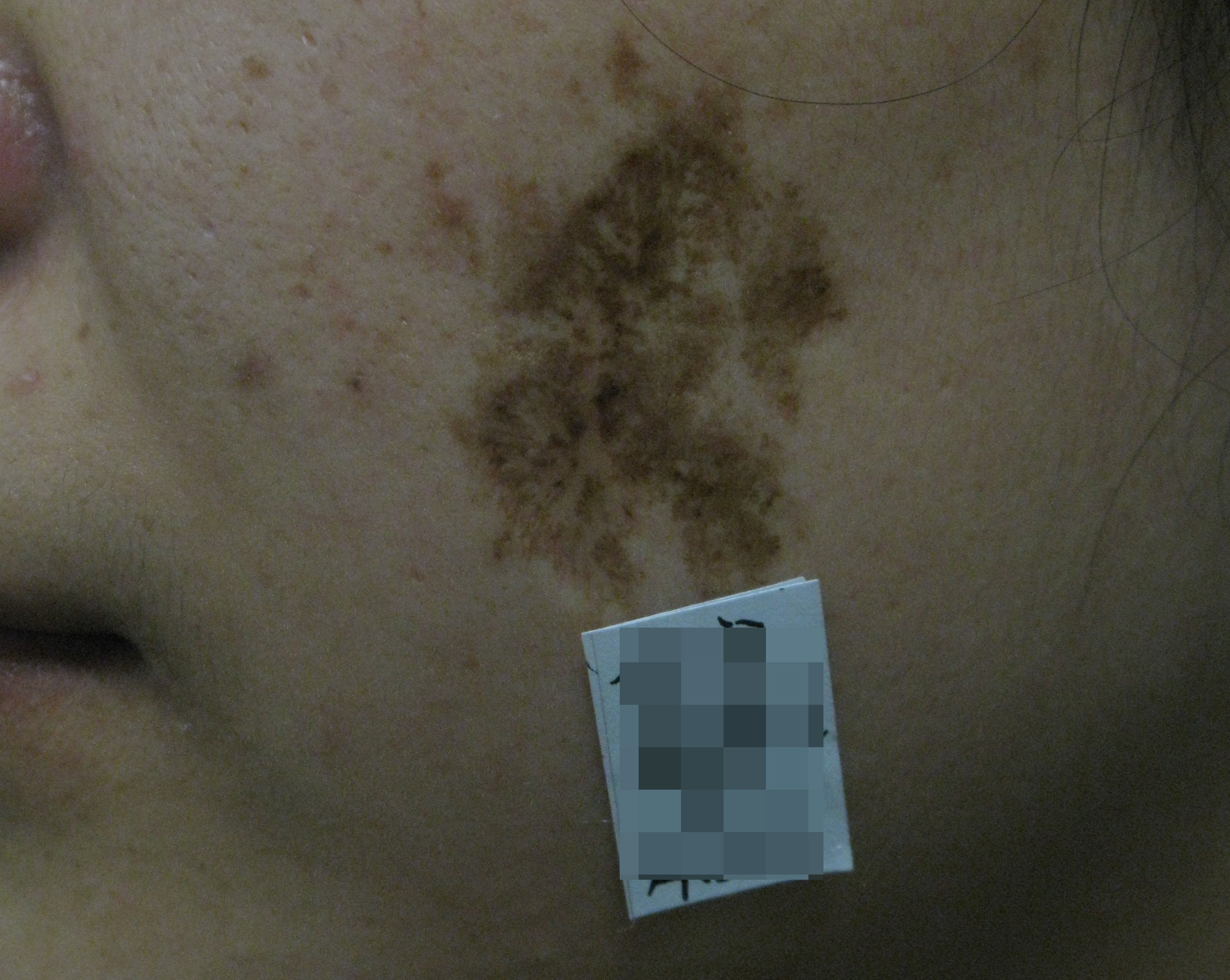 张子春胎记疤痕,郑州第二中医院皮肤科张子春