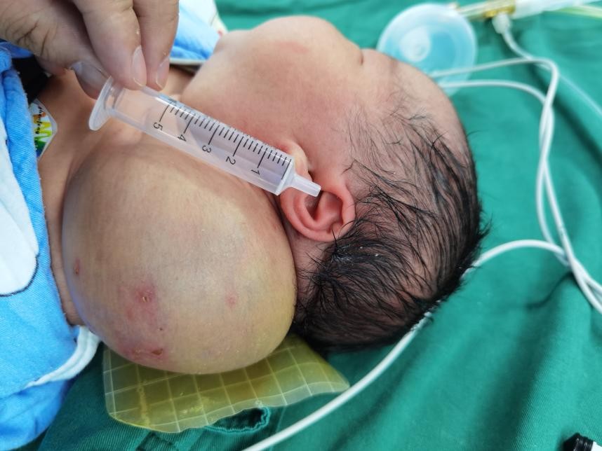 新生婴儿淋巴管瘤能彻底治疗吗,孩子不幸得了淋巴管瘤