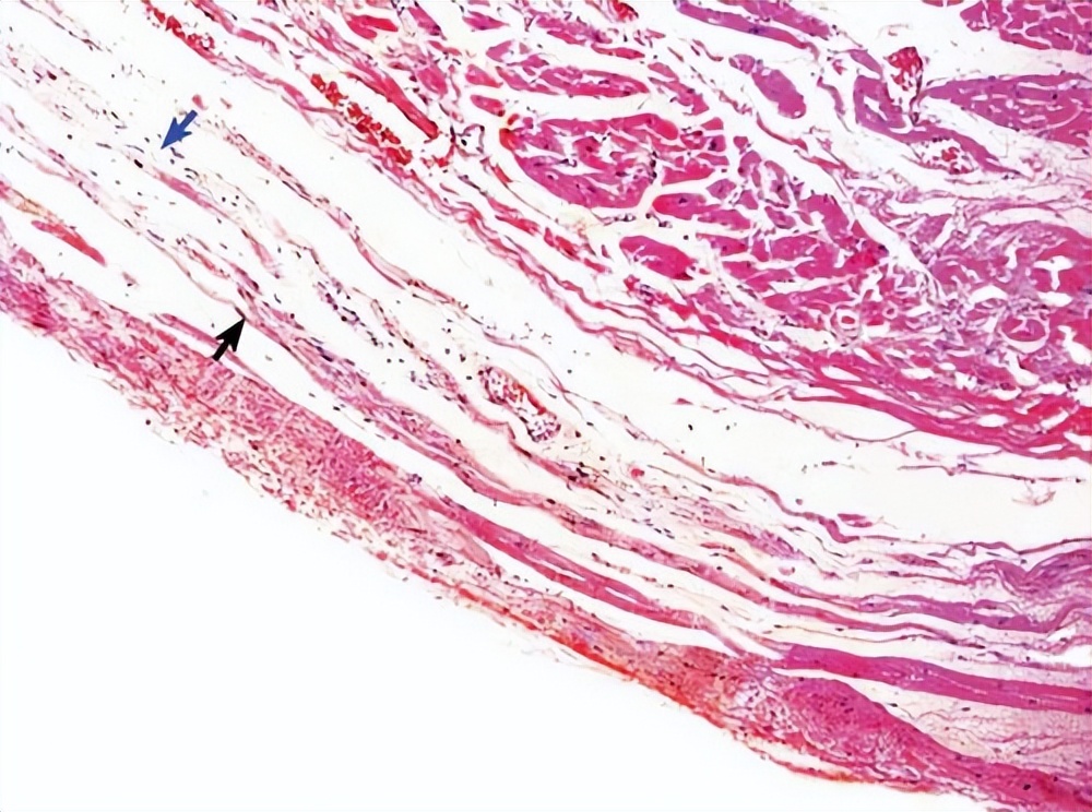 中医脚底筋膜炎如何彻底治愈,筋膜炎肩部最快的治疗方法中医