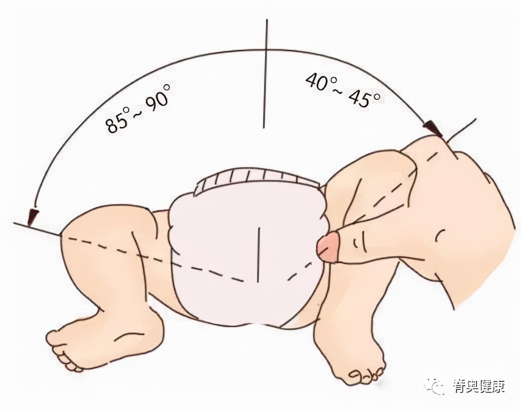 脊奥健康｜婴幼儿矫正案例—先天性髋关节发育不良+Tübingen支具