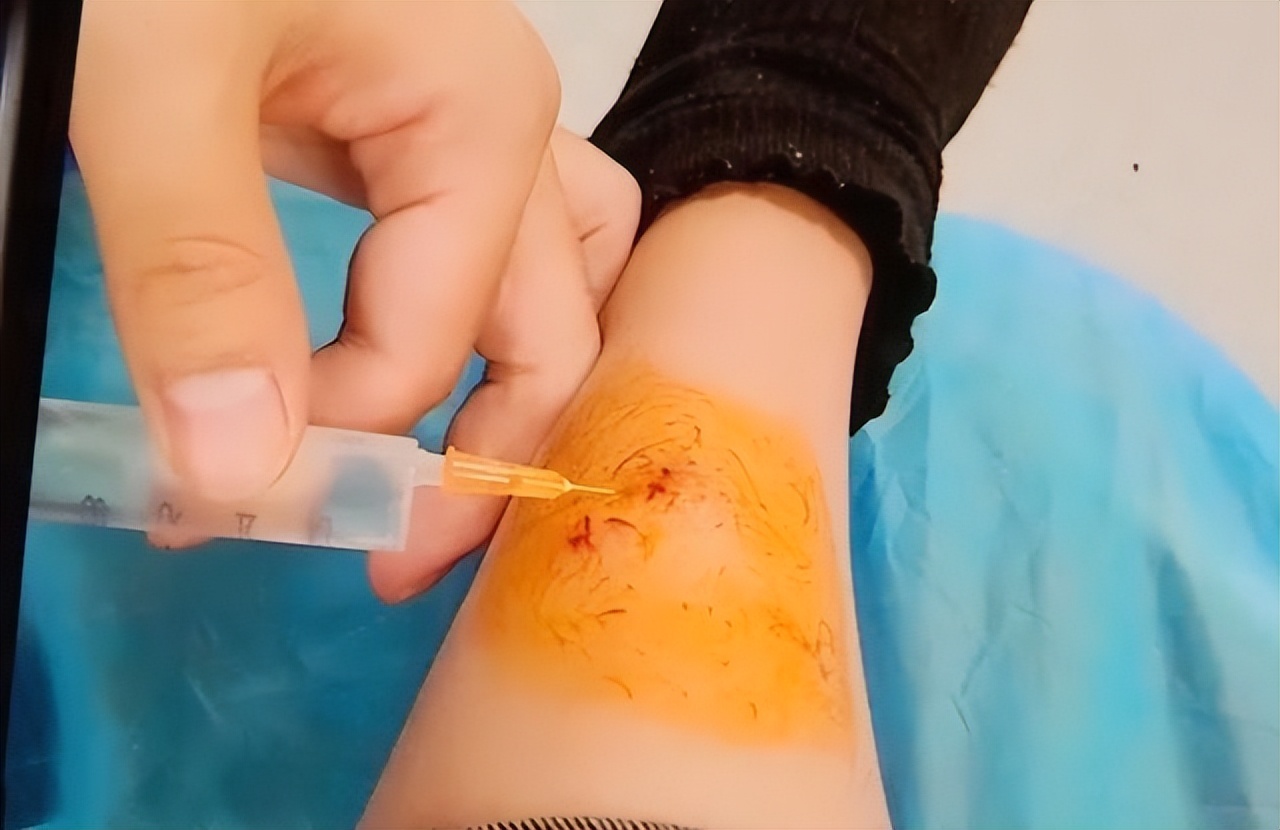 被猫抓伤在家怎么自救,被猫抓伤如何自救