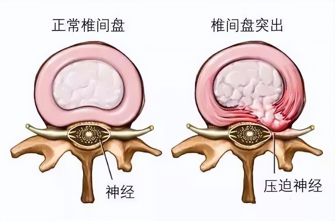 长期右腿承重会导致哪边肩高,长期下肢酸胀怎么回事