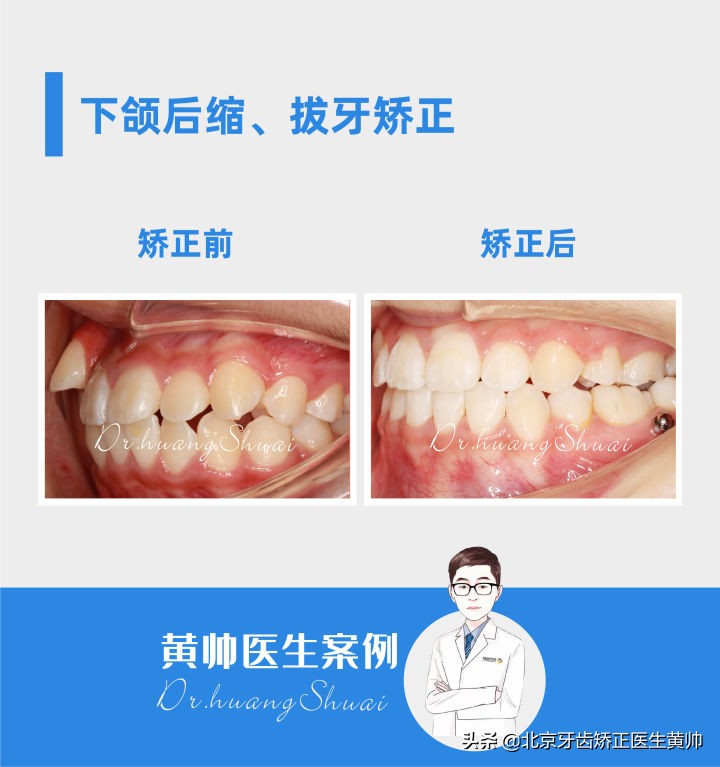 嘴凸的人怎么笑起来好看,嘴型比较凸的人怎么改善