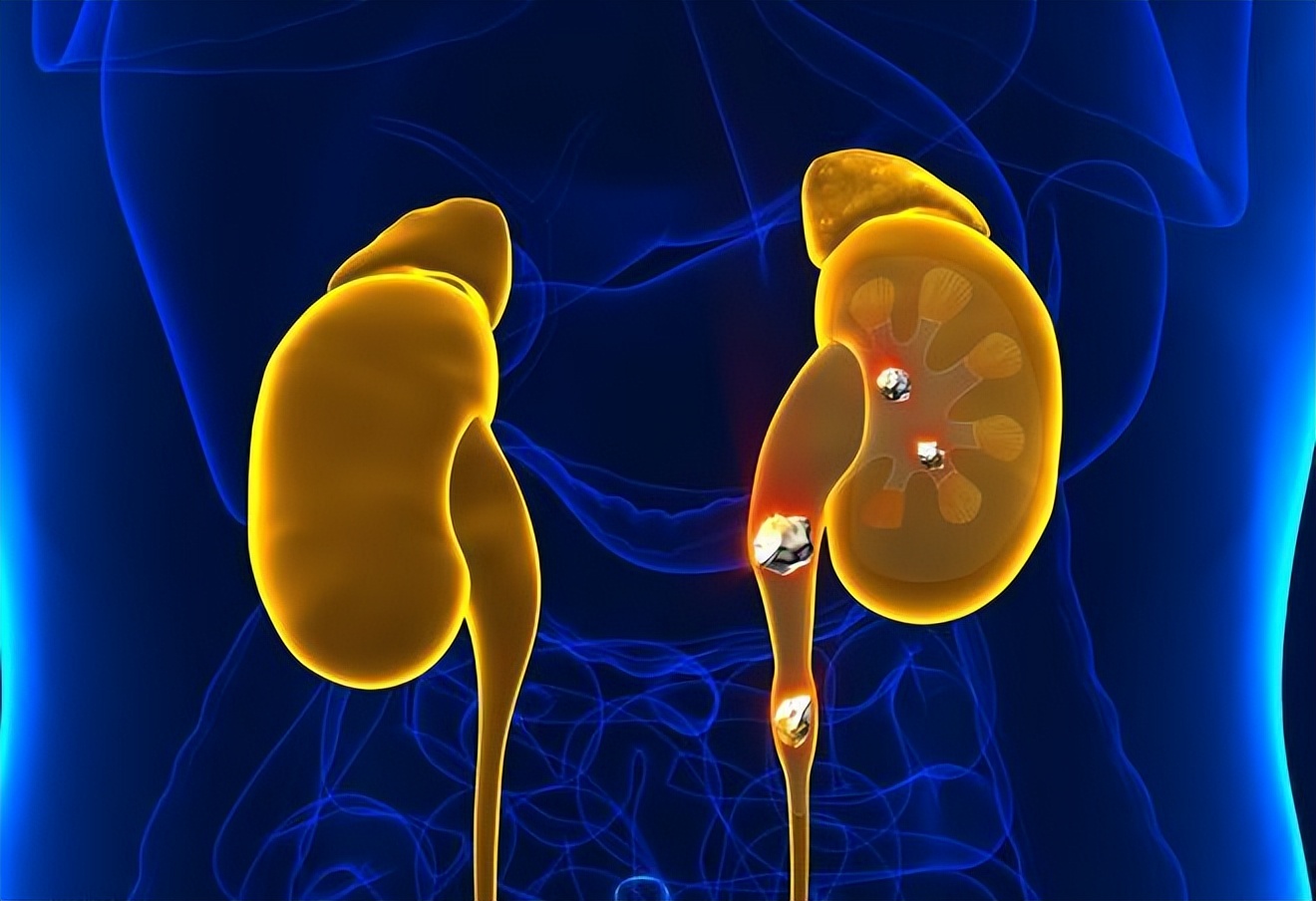 为什么痛风什么都注意了还会发作,为什么痛风用药反而更严重了