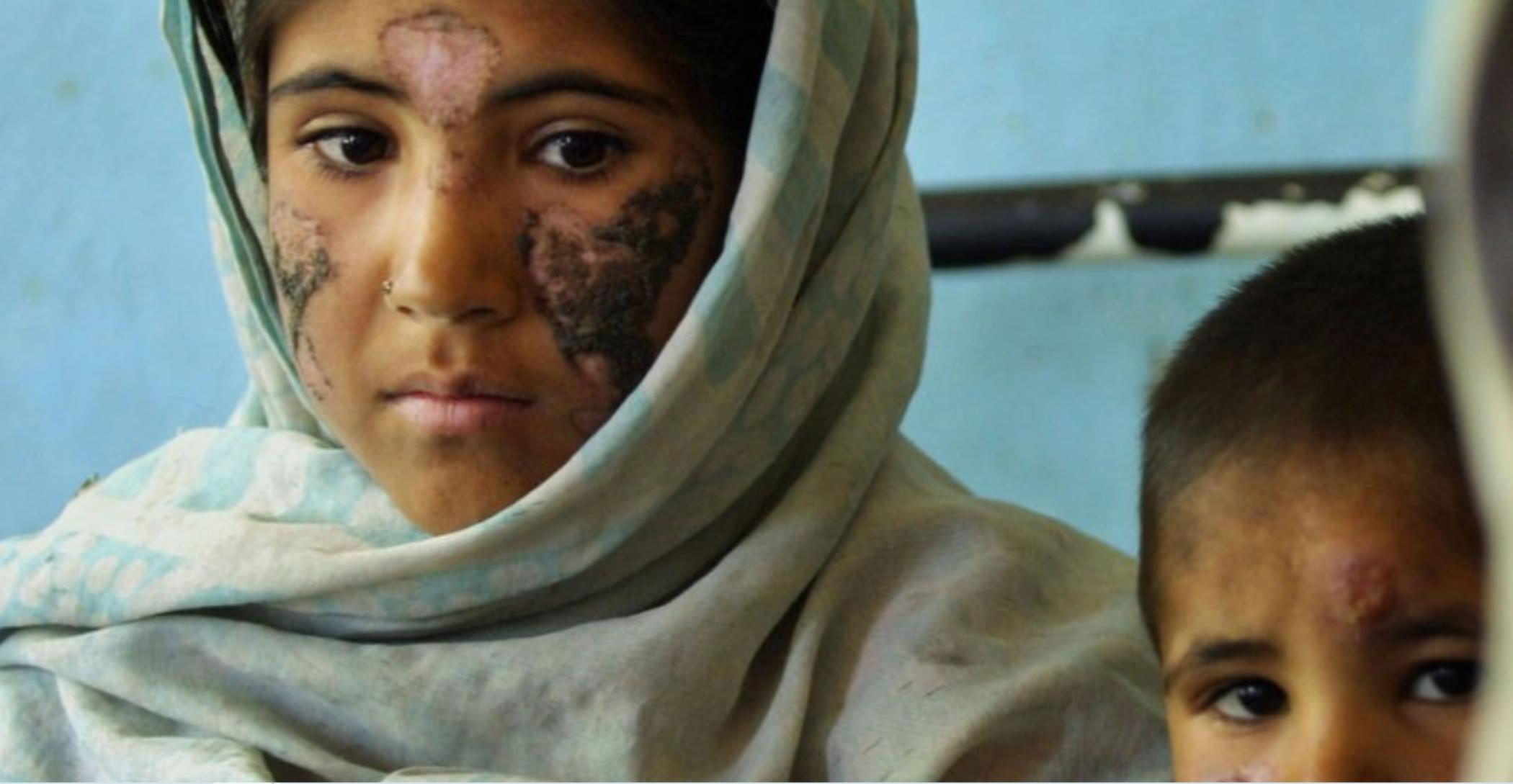 黑热病怎么样才算治愈了,狗狗黑热病如何预防