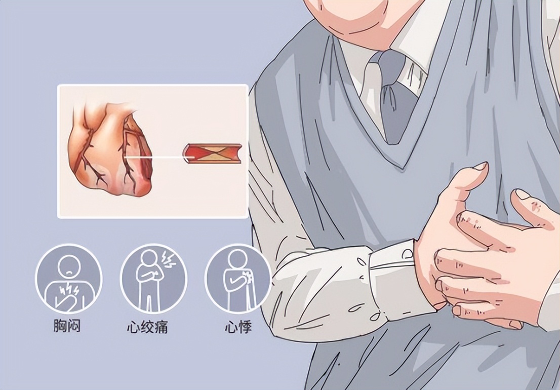 氯吡格雷可以长期替代阿司匹林吗,阿司匹林和氯吡格雷有替代品吗