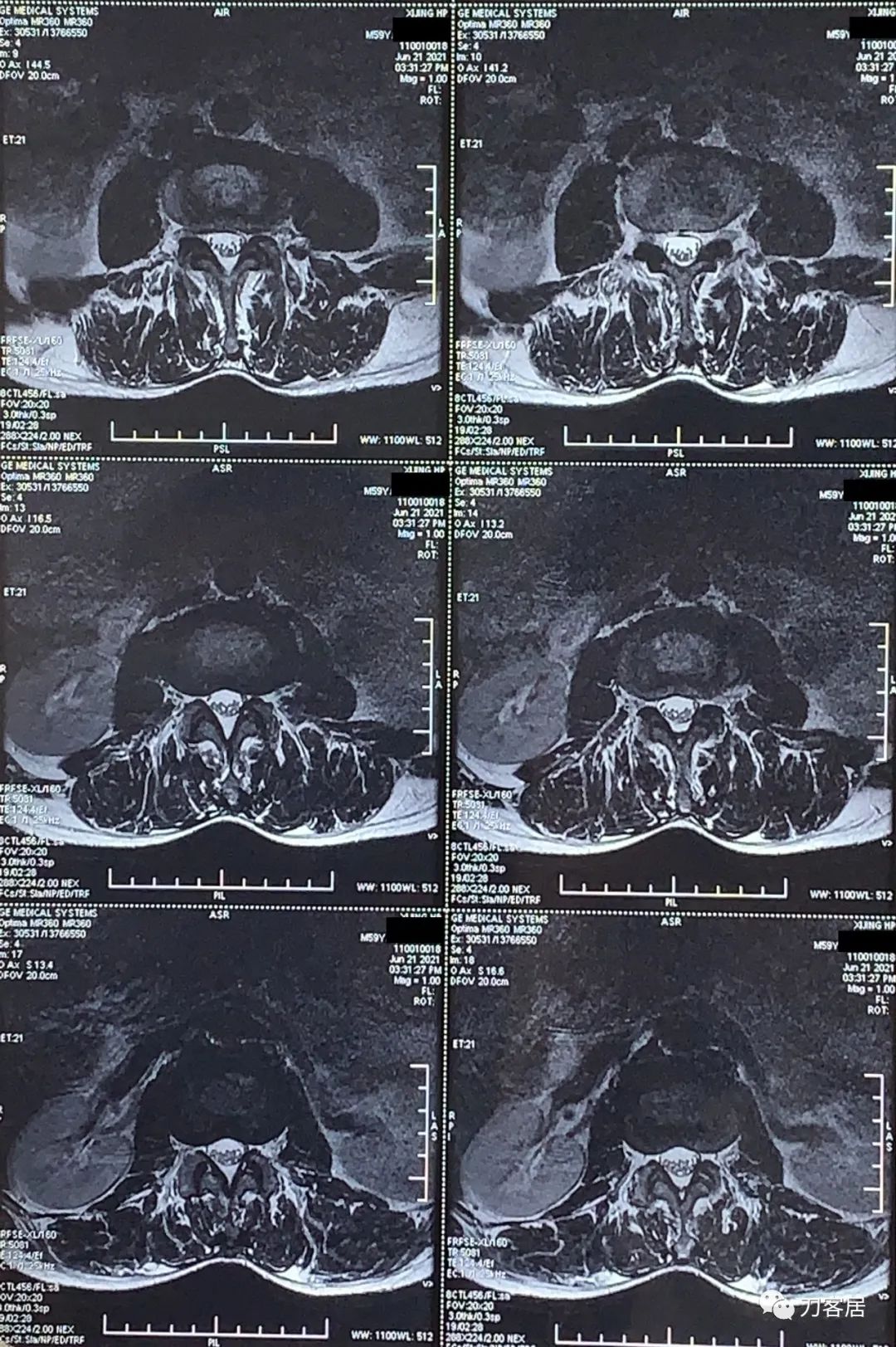 髋部疼，小腿肚胀、抽筋，折腾了5年没效果，能用阿仑膦酸钠吗？