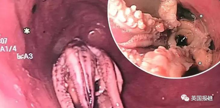 男子吞咽困难狂吐，医生检查吓呆：章鱼卡在体内，触手堵死食道！