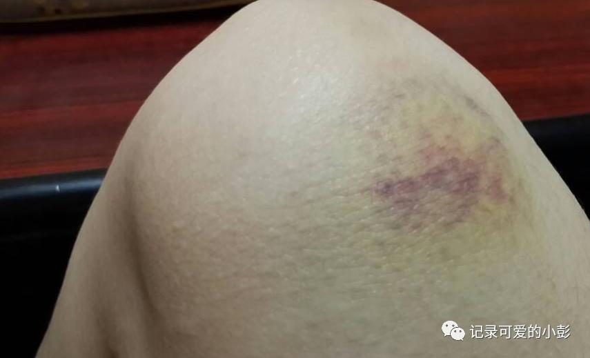 女儿下身发炎红肿怎么办,女儿下眼皮红肿