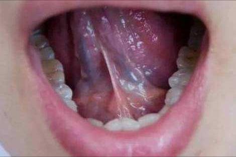 中药化痰祛湿良方,中药有较快消除痰栓的吗