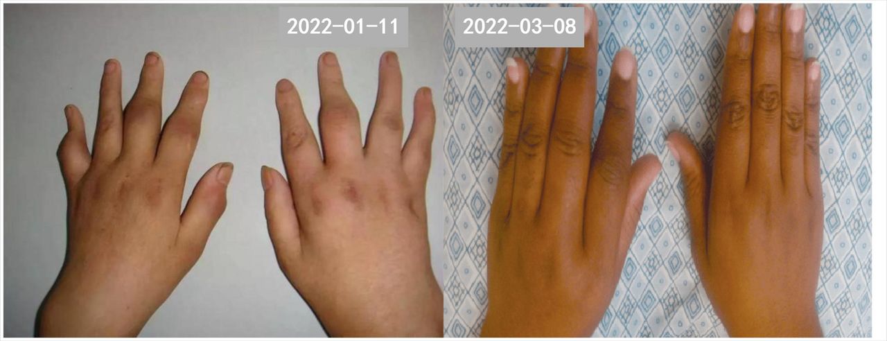 产后关节痛类风湿因子94,类风湿关节炎患者产后症状加重