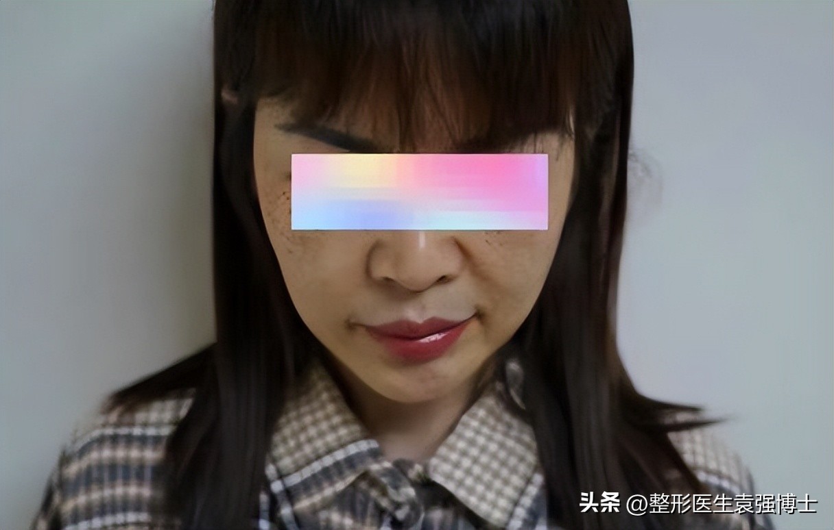 做拉皮手术会越来越薄吗,拉皮手术危险有真相