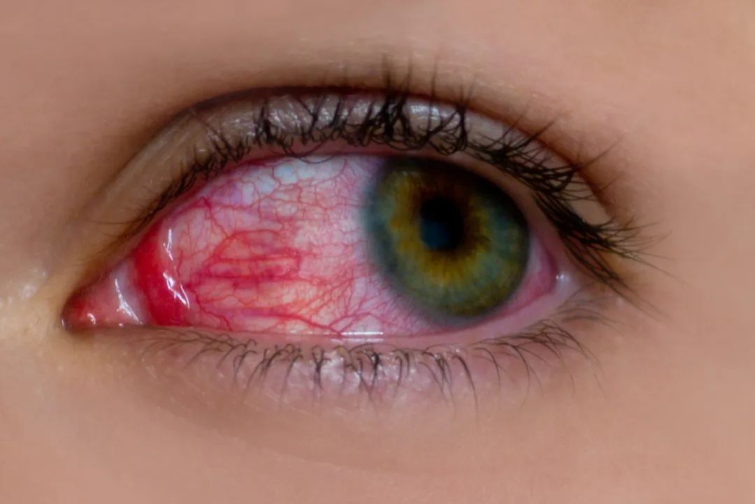 水上乐园游泳得妇科病,水上乐园感染红眼病