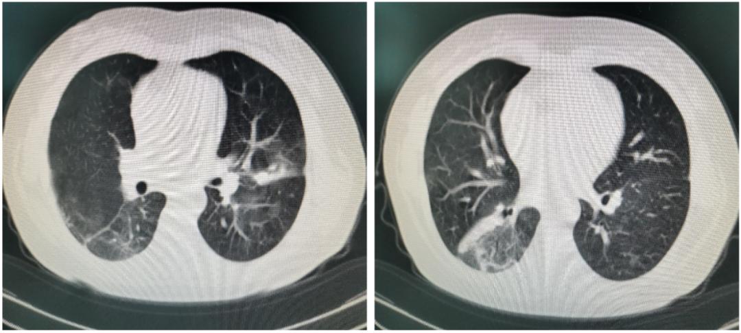 劳累引起发烧反复,劳累后发热属于气虚发热么