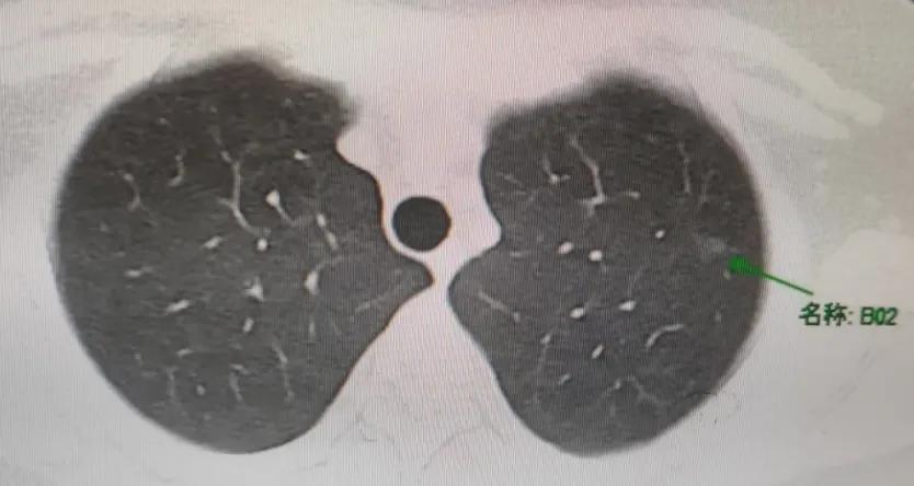 9mm恶性磨玻璃结节肺癌几期,磨玻璃结节8mm同家医院随访8年
