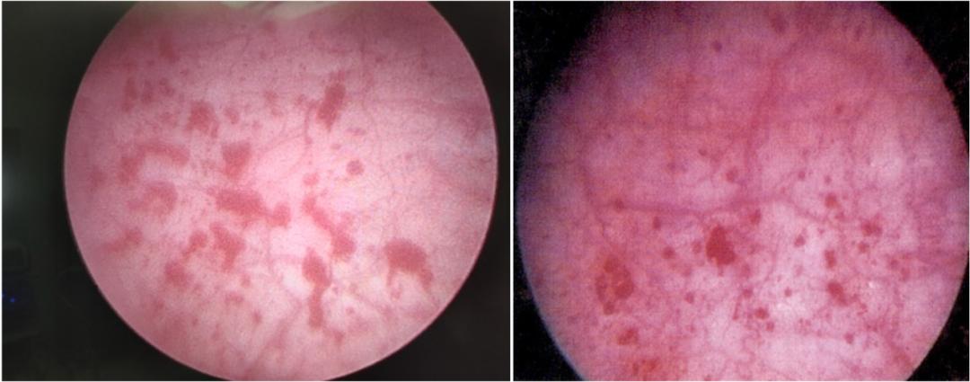 prp治疗间质性膀胱炎,间质性膀胱炎prp治疗价位