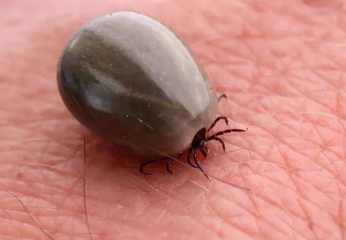 妈妈帮孩子理发发现蜱虫,小孩儿头上发现有蜱虫