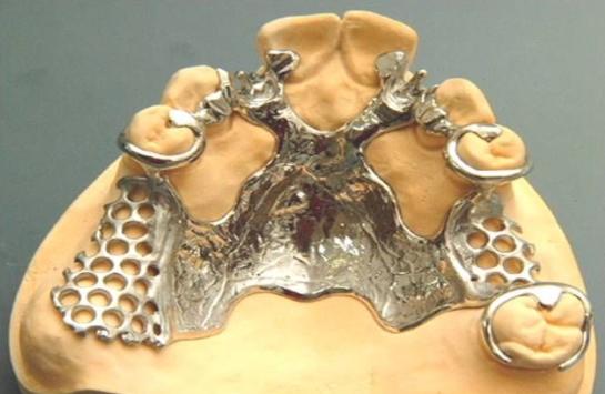 有比较好的活动假牙吗,戴了多年的活动义齿种牙