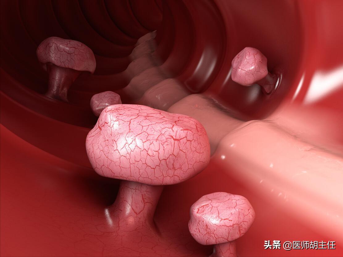 如果肠道长息肉身体会有哪些反应,肠道长息肉会有什么症状