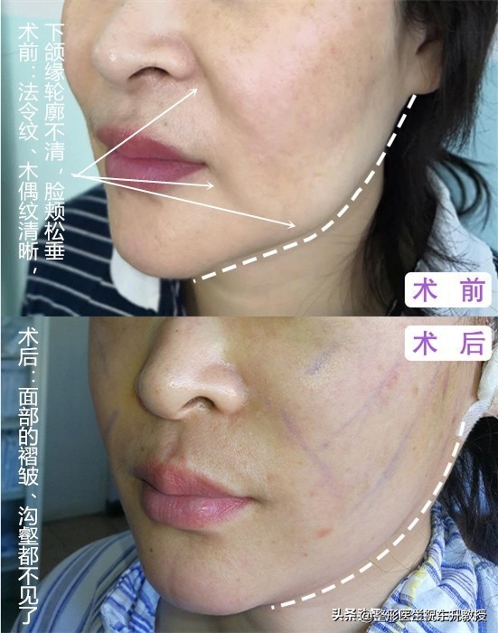 拉皮改善法令纹手术的危害有哪些,脸部法令纹做手术怎么去除