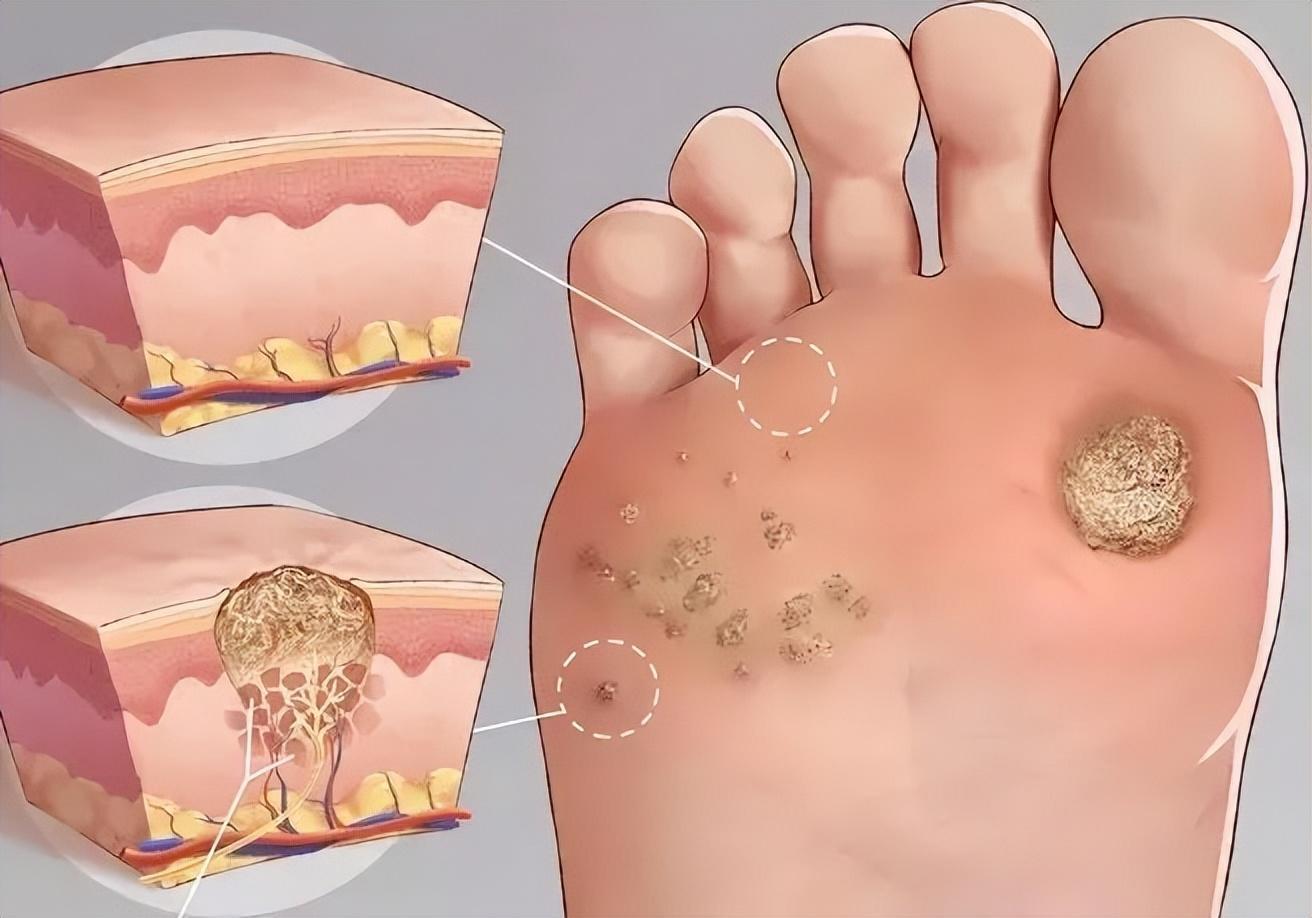 脚底板爱出汗怎么解决,脚底板爱出汗是什么原因造成的