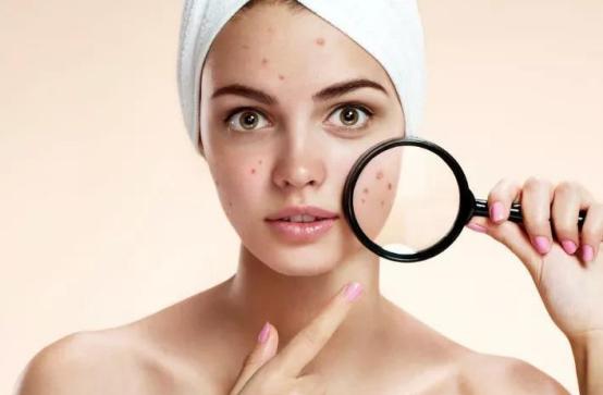 怎样才是治痘的最好方法,痘不痛祛痘有效的方法