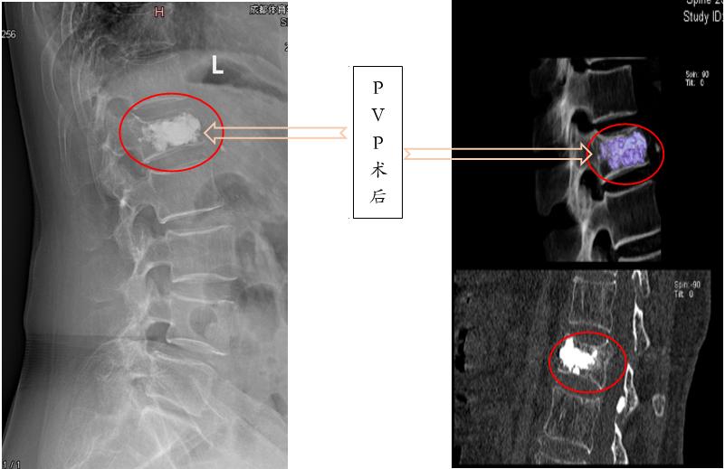 胸腰椎压缩性骨折特色治疗方法,老年人胸腰椎骨折怎么治疗