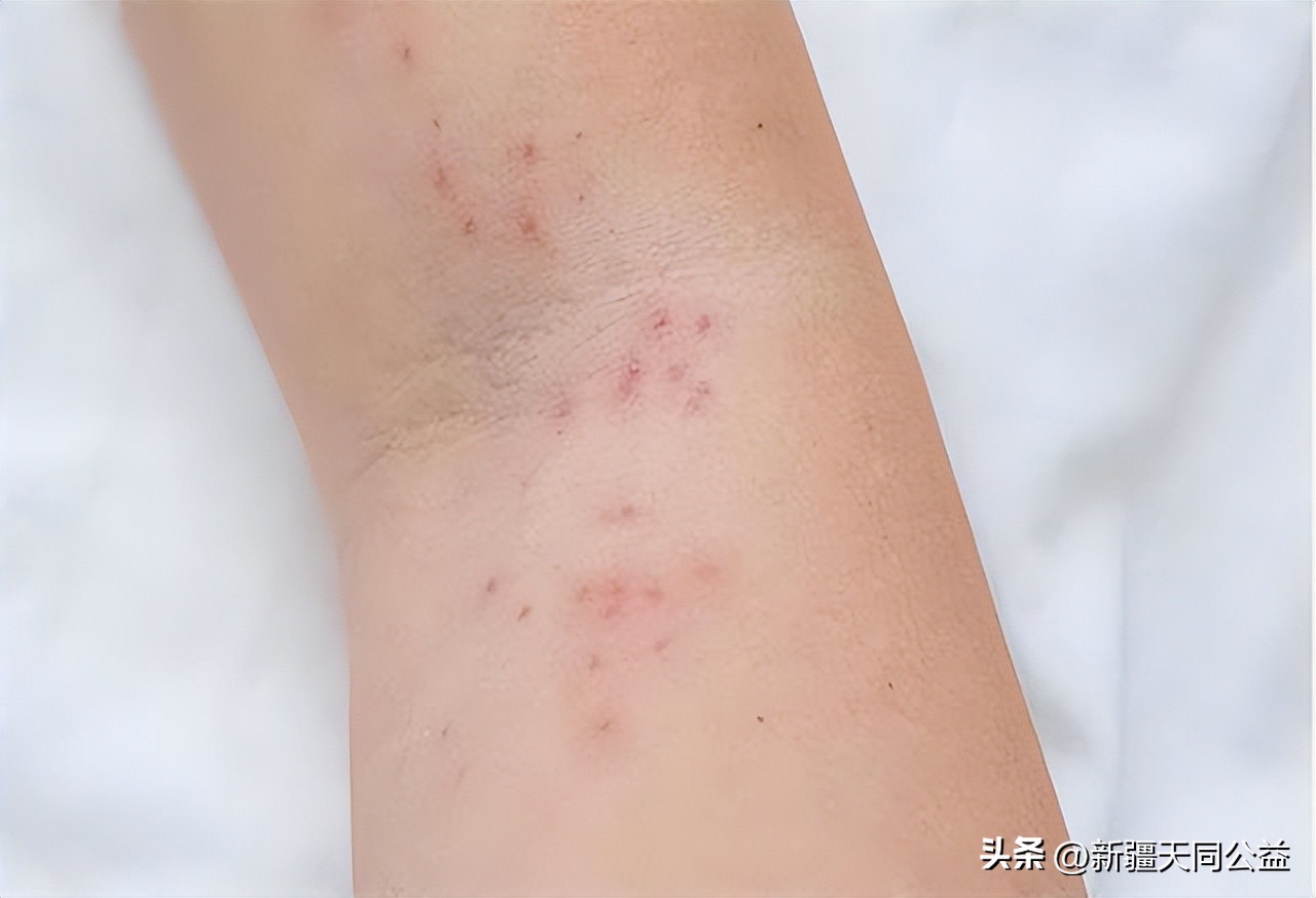 不要错把艾滋病当皮肤病，身体若有3变化，或是艾滋病的信号