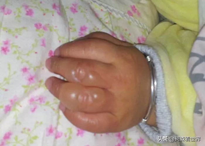 烫伤感染怎么处理,孩子在学校被同学烫伤怎么处理