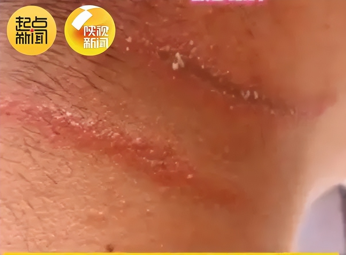 “我的脸被它毁容了…”毒液堪比硫酸！西安也有！