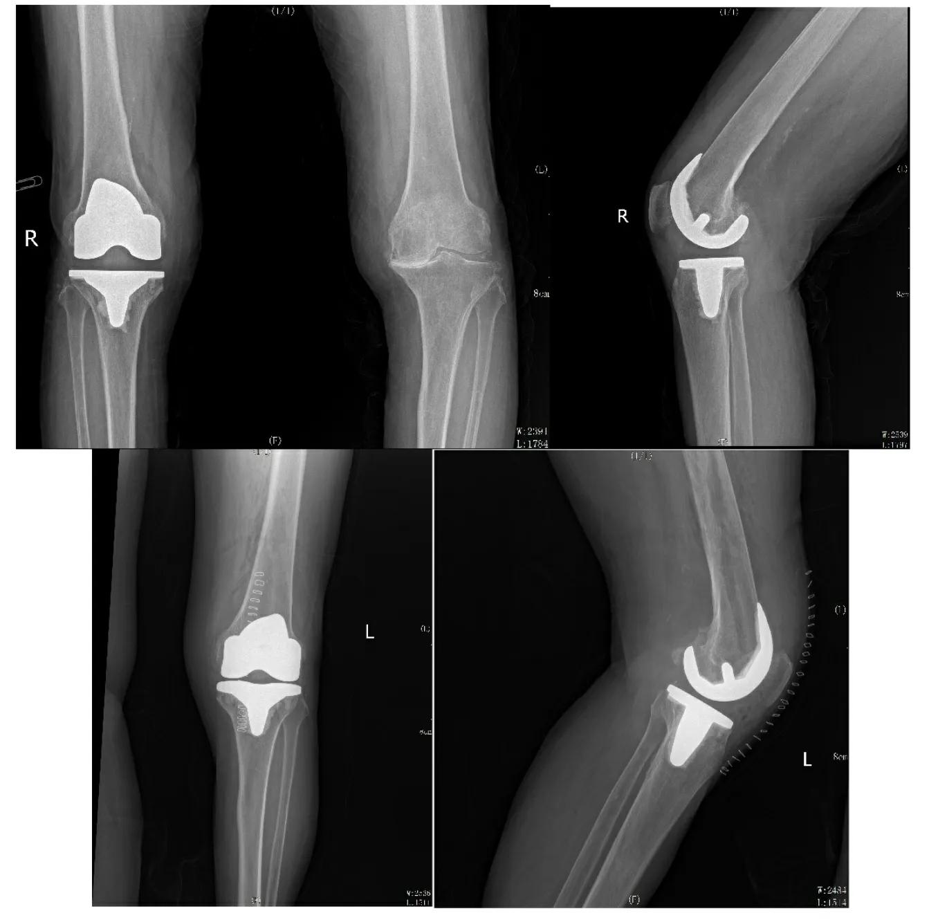 双膝重度骨性关节炎诊疗一例---匠琢骨科