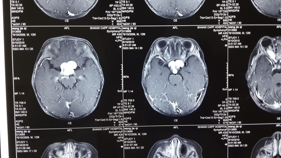 贺晓生教授胶质瘤的手术治疗实例,贺晓生神经外科教授视频