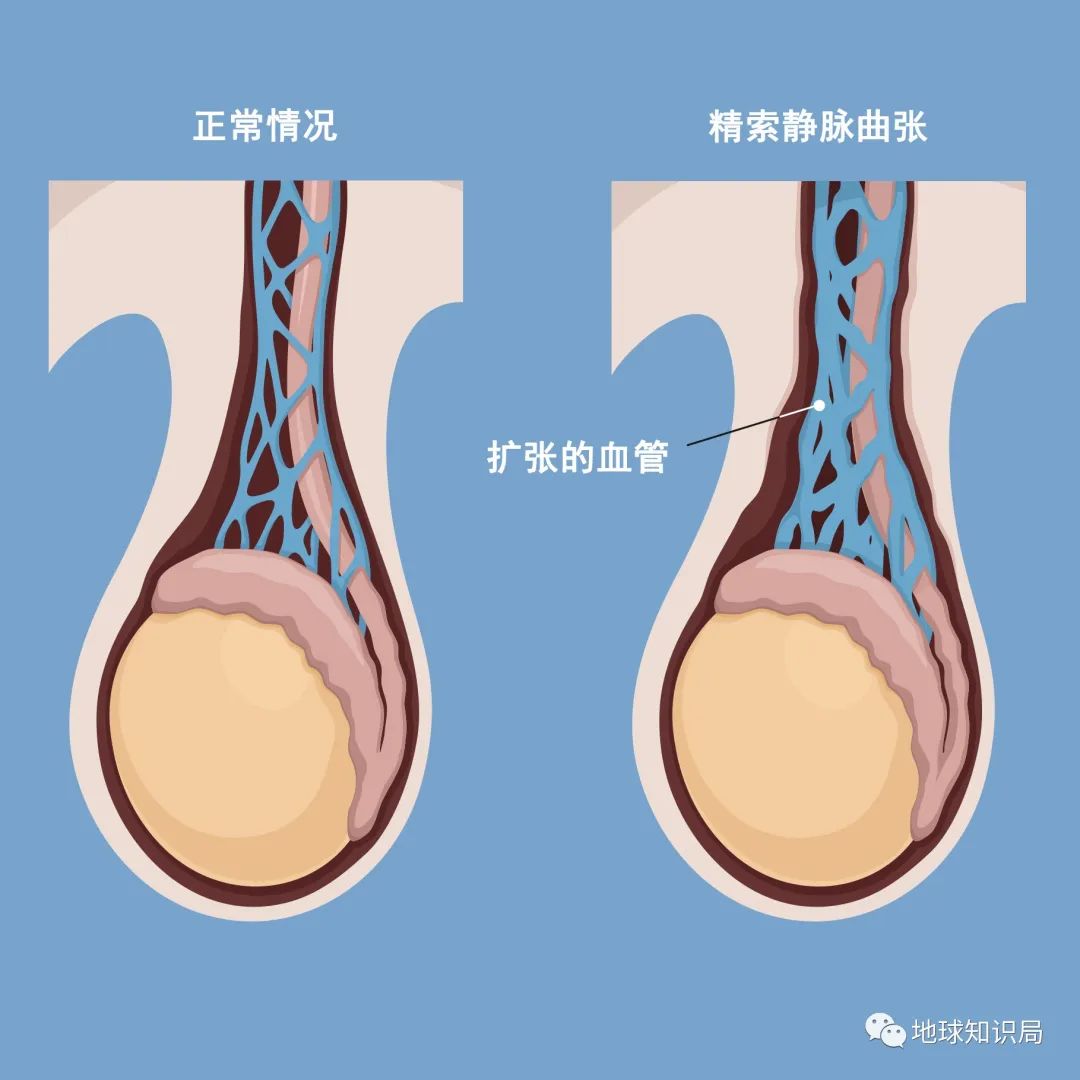 男子精子断崖式下降,男精子数量