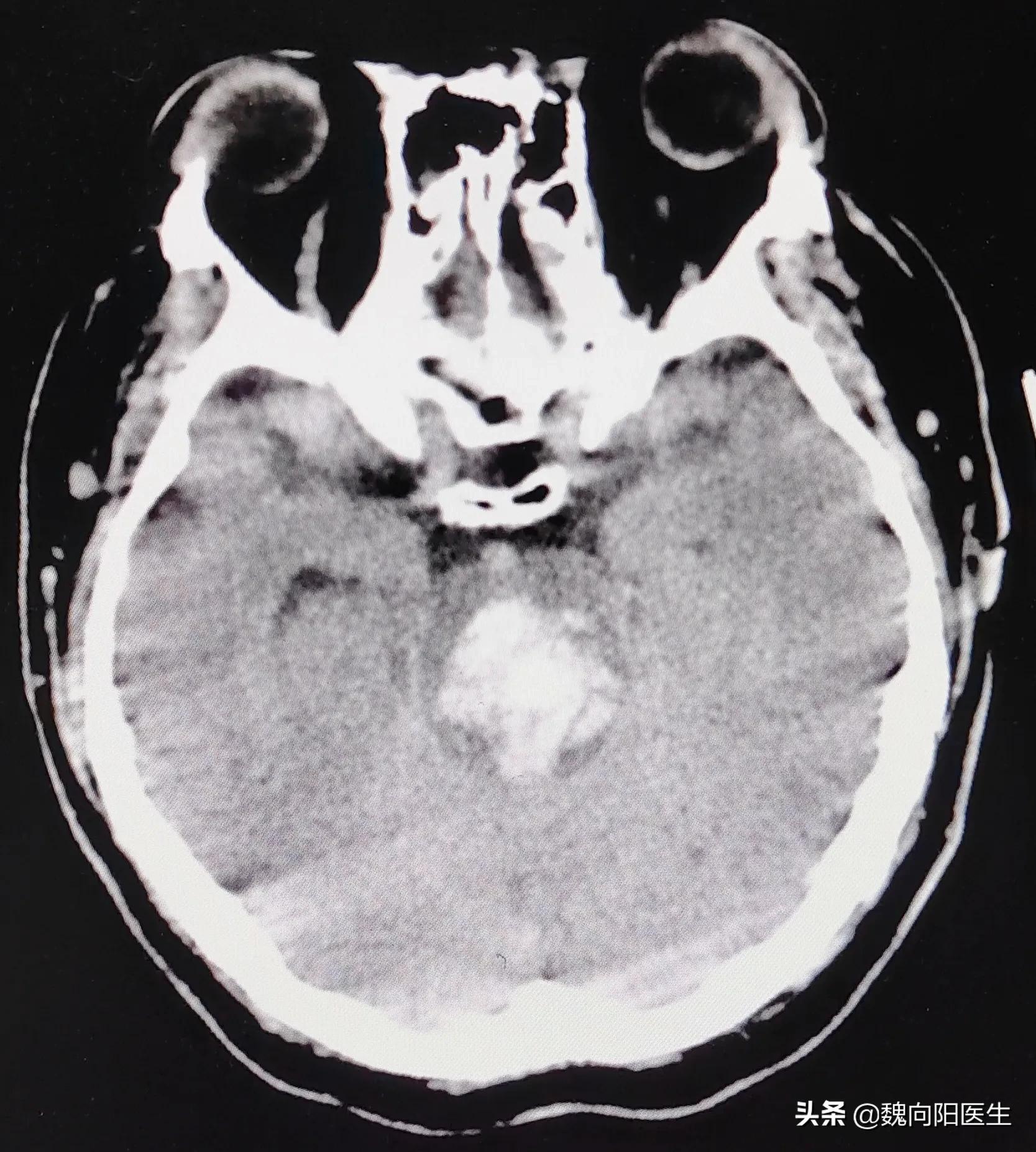 脑干出血后治疗好后有什么后遗症,脑干出血后续怎样康复