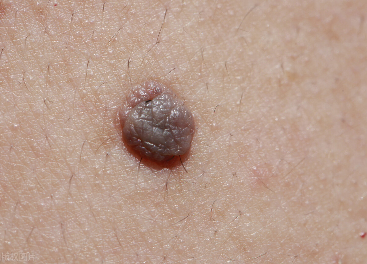 瘊子和刺瘊的区别,瘊子是很常见的疾病吗