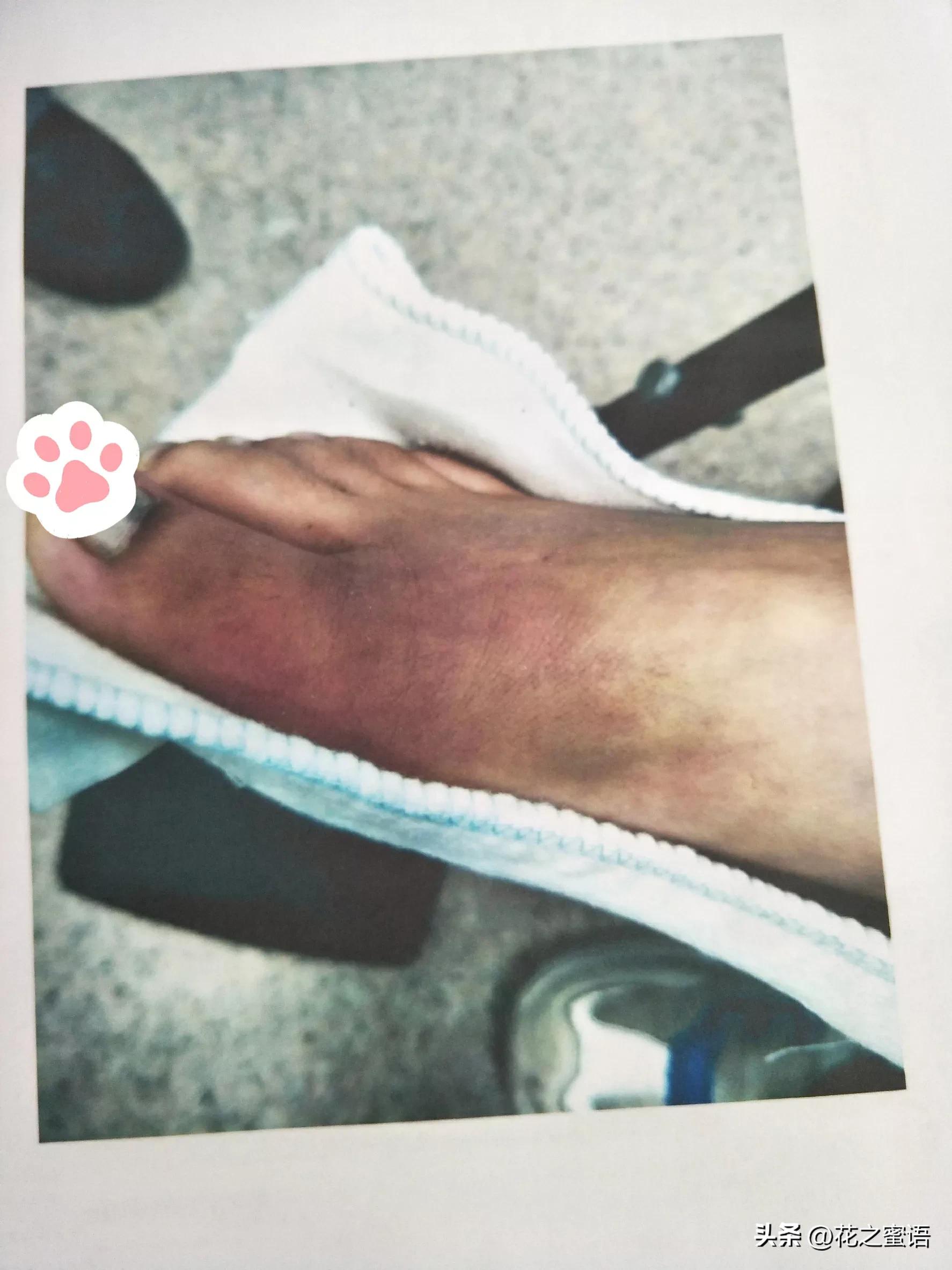 孩子在学校厕所摔骨折了怎么处理,小孩子在学校头被砸了怎么处理